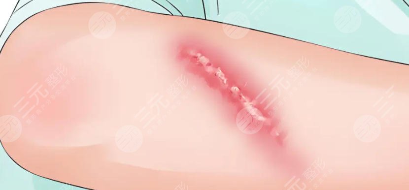疤痕