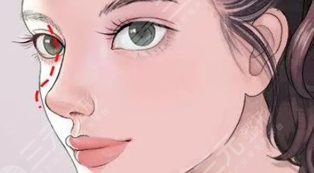 隆鼻