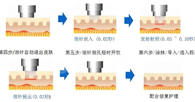 黄金微针