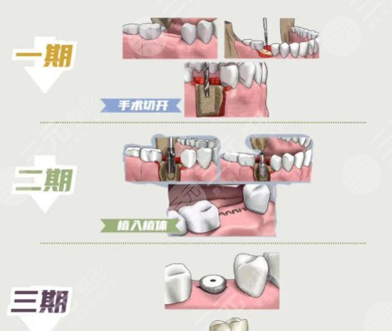牙齿种植