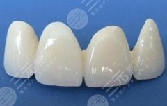 钯银合金烤瓷牙怎么样？材料种类一一了解