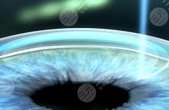 怎么恢复近视眼？调节方法、副作用、价格一览速看！
