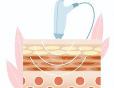 激光治疗痤疮几次有效？具体次数、价格、恢复期这看