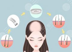 头发油腻又脱发怎么办？这些方法值得了解