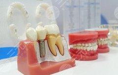 北京种植牙多少钱？价格明细、术后注意事项、维持时间速码