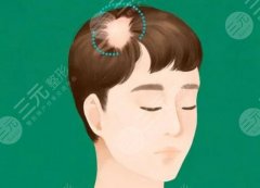 斑秃是什么原因？产生原因、调节方式这里看