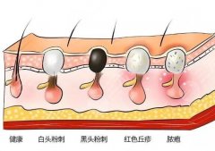 去黑头收缩毛孔医美怎么样？项目优势、科普信息在线看