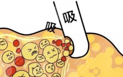 泰安中心医院吸脂多少钱？2026年医院腰腹、大腿和手臂收费参考