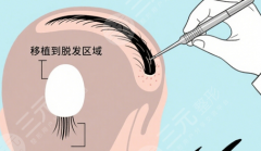 济南市中心医院植发价格表2026版更新｜不同脱发面积与毛囊数量收费参考