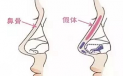 川北医学院附属医院假体隆鼻多少钱？不同材料与手术方案价格详细拆分