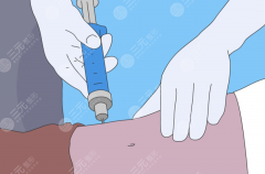 潍坊吸脂手术哪家比较好？腰腹、大腿和手臂吸脂选院避坑攻略
