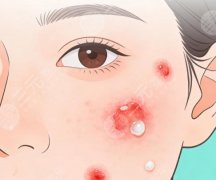 鼻子上挤出白色的东西是什么？正确处理方法看这里