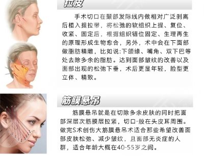 筋膜提升