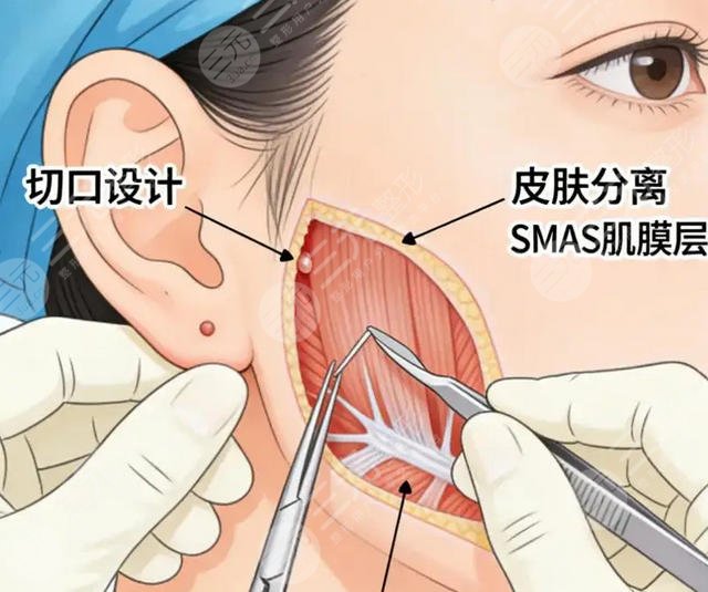 拉皮