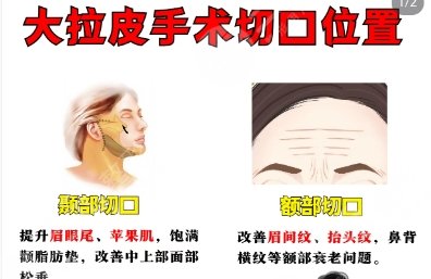 拉皮