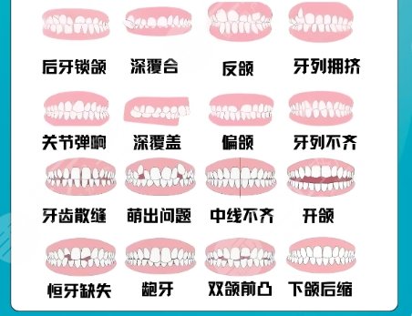 正颌