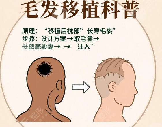 植发