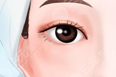 双眼皮