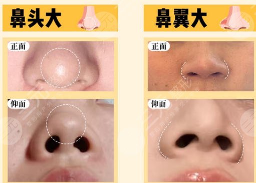 隆鼻