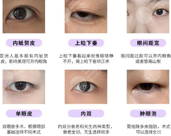 双眼皮