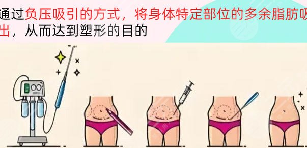 吸脂