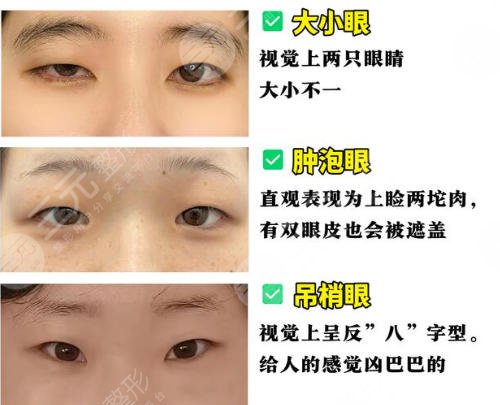 双眼皮