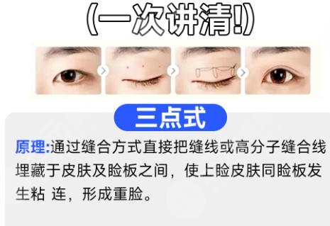 双眼皮