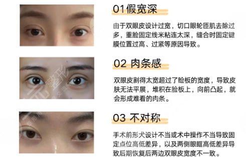 双眼皮