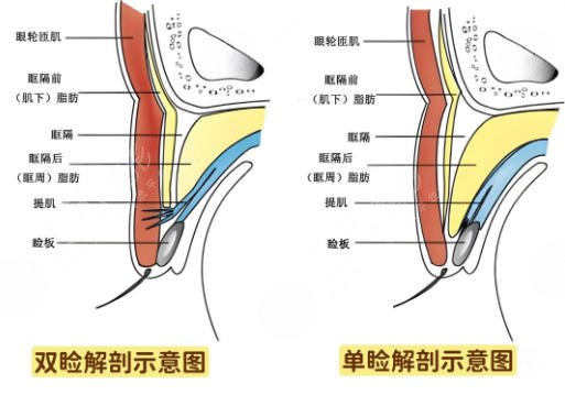 双眼皮