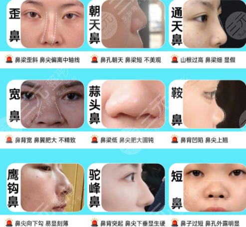 隆鼻
