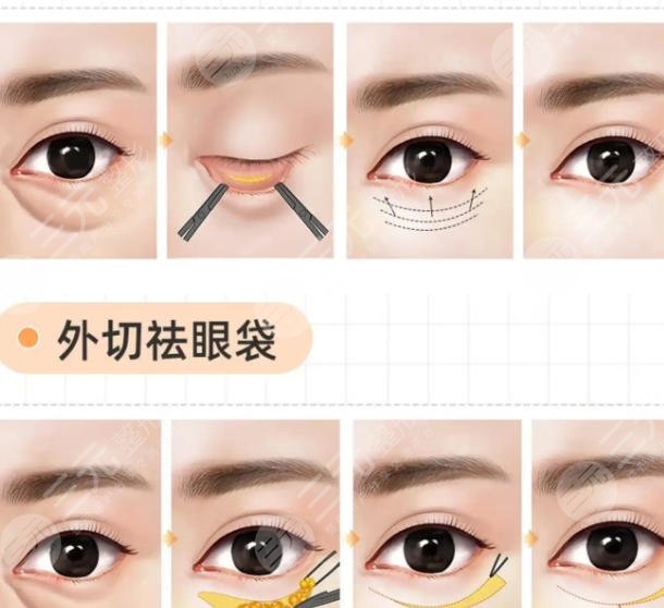 去眼袋