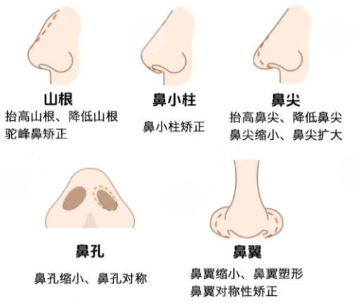 隆鼻