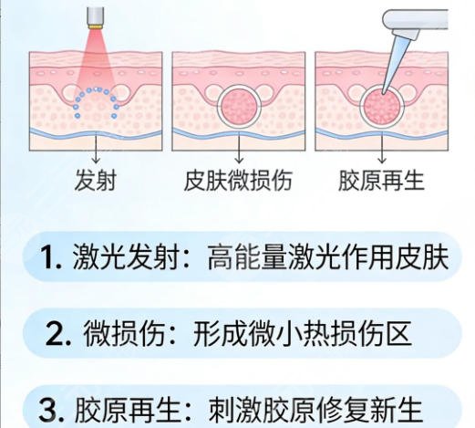 点阵激光