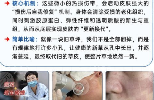 点阵激光