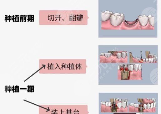 牙齿种植