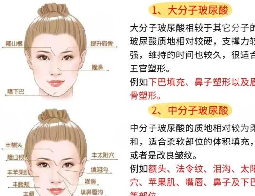 注射玻尿酸