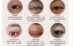 西京割双眼皮多少钱？价格详情、口碑医生、案例都有！