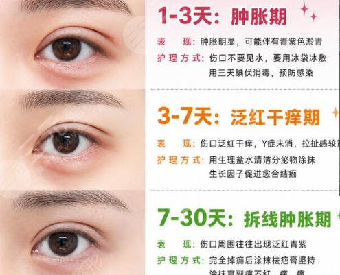双眼皮