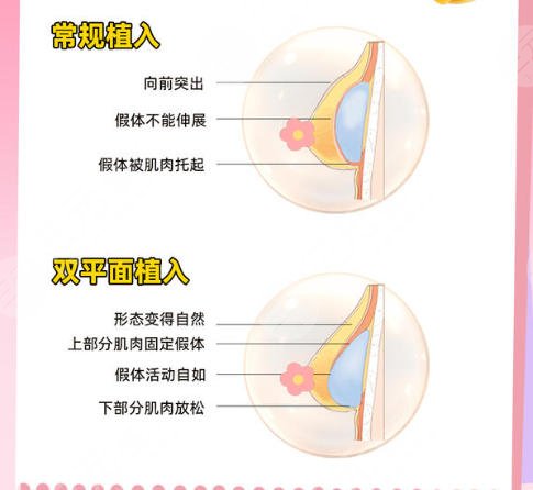 隆胸
