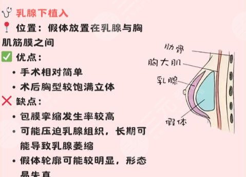 丰胸