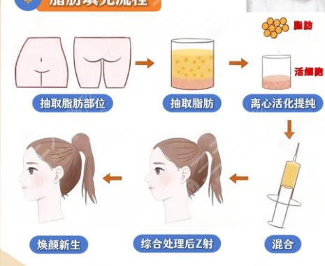 脂肪填充