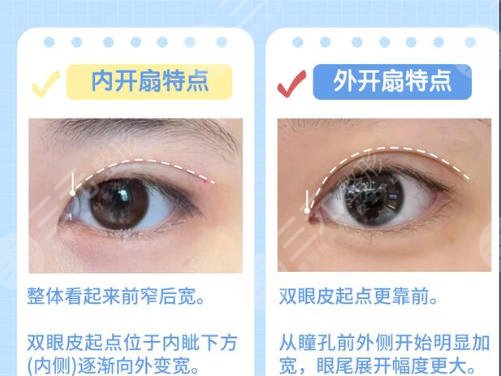 双眼皮