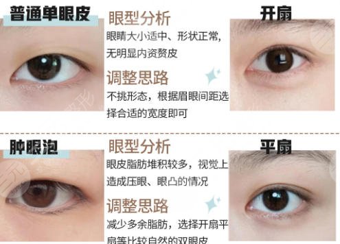 双眼皮