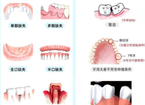 牙齿种植