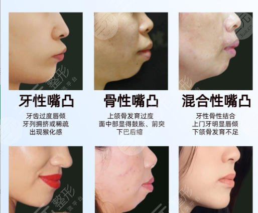 牙齿矫正