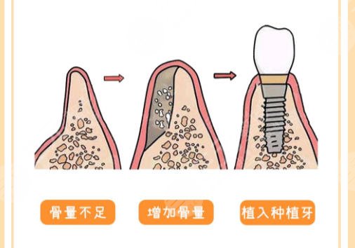 种牙