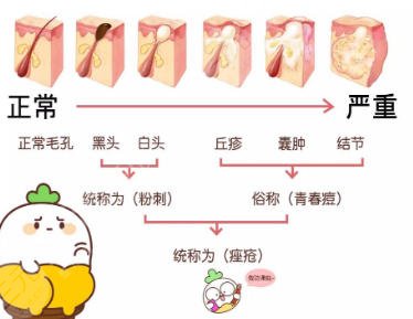 祛痘