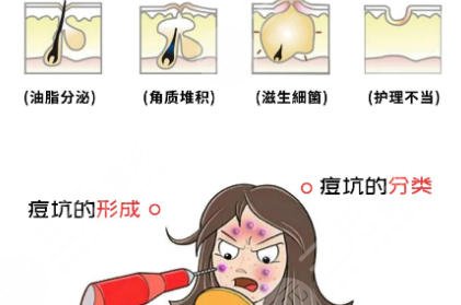祛痘