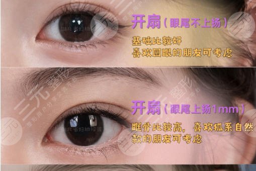 双眼皮