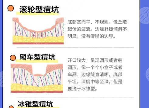 点阵激光